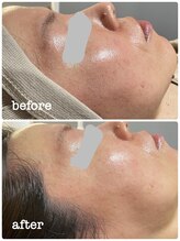 ニコリ(Nicori)/シェービングエステ