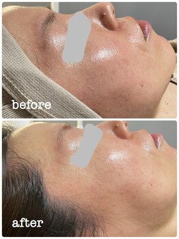 ニコリ(Nicori)/シェービングエステ