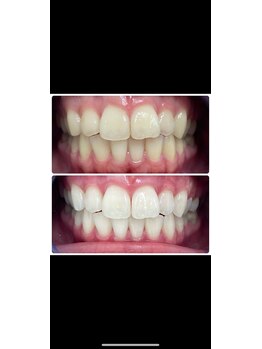 コナホワイトニング 神保町/ホワイトニング