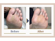 巻き爪補正店 錦糸町店/【タコ・魚の目ケア】