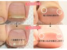 巻き爪(親指)補正 1/1