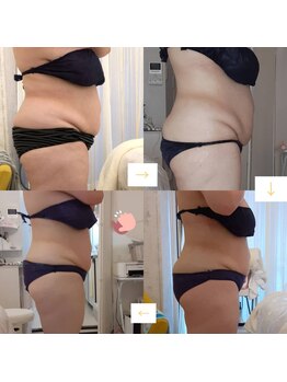 ハズキ(HAZUKI)/結果の出る痩身