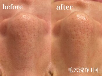 エンソワー(en'sower)/毛穴洗浄で肌をリセット！