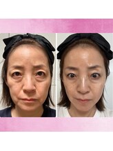 アイリープ(eyeleap)/☆MEDICHOUTHIQ炭酸パック