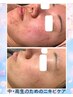 思春期ニキビにお悩みの方に