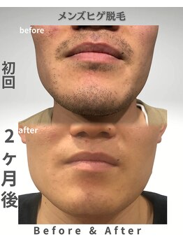 ニチワ 御器所店(NICHIWA)/ヒゲ脱毛