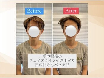 エモア メディカル整体院 恵比寿院(Emoa)/【20代男性】小顔矯正