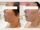 ビビラフィネ(BiBi Raffine)の写真/【フェイスラインをすっきり整える】ラジオ波×小顔マッサージで理想の小顔印象と若々しい横顔へ★

