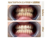 エイム(EIM)/セルフホワイトニング