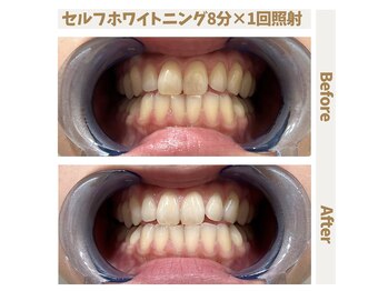 エイム(EIM)/セルフホワイトニング