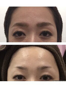 ミニョン(mignonn.)/ダーマケア