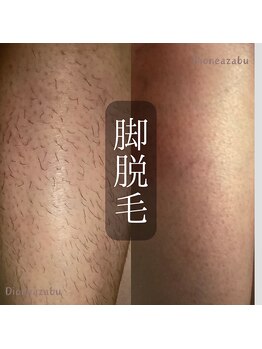ディオーネ 麻布十番(Dione)/【脱毛】ひざ下