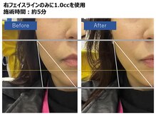 スパークリングセルフ(Sparkling Self)/レモンボトル　施術前後