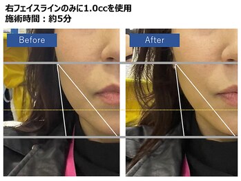 スパークリングセルフ(Sparkling Self)/レモンボトル　施術前後