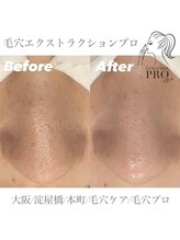 オーバイルッカ(O by RUCCA)/毛穴エクストラクションプロ