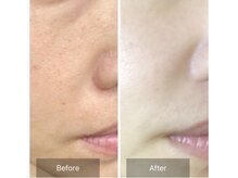 エミルカ 千葉店(EMILUCA)/ハーブピーリング顔/毛穴ケア