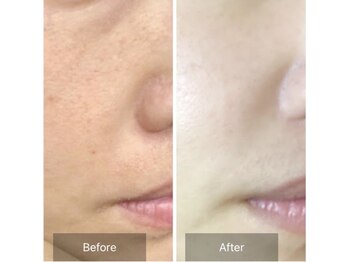 エミルカ 千葉店(EMILUCA)/ハーブピーリング顔/毛穴ケア