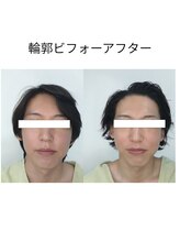 ソフィーム/男子リフト肌　ビフォーアフター