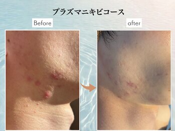 コンフィ(Comfy)/プラズマニキビ