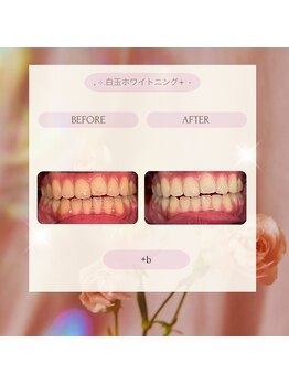 プラスビーセルフ(+b self)/ホワイトニングビフォーアフター