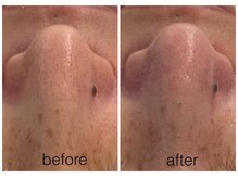 ハリスキンラボ(Hari.Skin.Lab)/40代のお客様/1回の施術結果