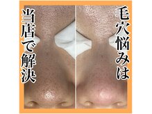 毛穴エクストラクションプロ。毛穴汚れ黒ずみ、開きを解決！