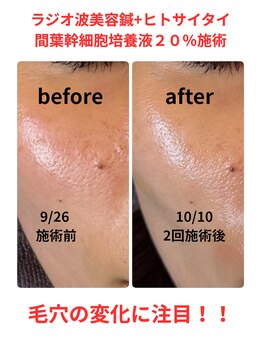 セットアップ鍼灸院(setup鍼灸院)/幹細胞美容鍼