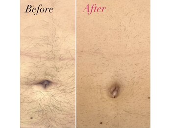 リル(Lil)/お腹・おへそ周り2回目終了！