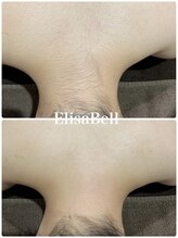 エリーザベル(Elisa Bell)/背中脱毛途中経過