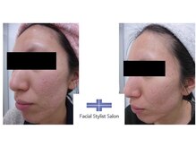 フェイシャルスタイリストサロン 高崎店(Facial Stylist Salon)/ケア例（33）