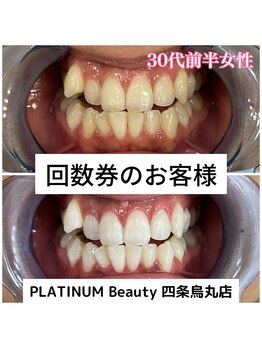 プラチナムビューティ 四条烏丸店(PLATINUM Beauty)/40分照射×5回！ホワイトニング!