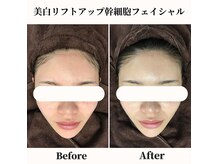 ヘアティブ アンド スキンベイビー 名古屋金山店(Hairtive&Skin Baby)の雰囲気（1回の美白リフトアップでお肌のトーンアップ♪美白効果◎）