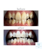 ホワイトニングショップ 長野店/光の当て方サポートします！