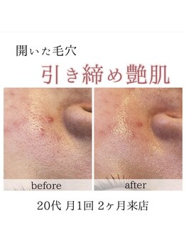 アネラ(Anela)/汚れをしっかり取らないと…