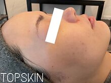 トップスキン 栄(TOPSKIN)/目指せ☆毛穴レス肌！
