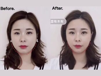 ユウキシキ(YUKISIKI)/YUKISIKI小顔矯正&美容鍼