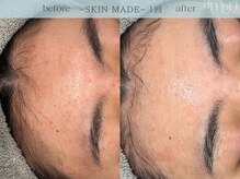 スキンラボアメリ(skin lab. ameri)/お悩み…ニキビ 敏感肌 ざらつき