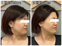 エミマス ボーテ(Emimas Beaute’)/表情筋ケアでここまで変わる！