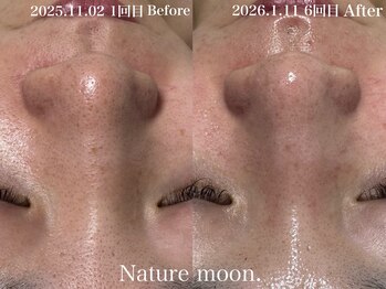 ナチュールムーン(Nature moon.)/毛穴洗浄