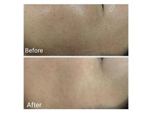 マインドール/施術1回 シワ、シミが変化