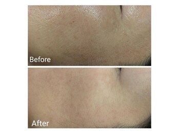 マインドール/施術1回 シワ、シミが変化