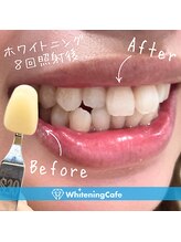 ホワイトニングカフェ 苫小牧店(WhiteningCafe)/ ◎歯のホワイトニング施術写真