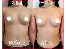 ティアラ(TIARA)/バストアップ症例