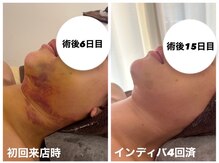 インディバケアプラチナム 心斎橋