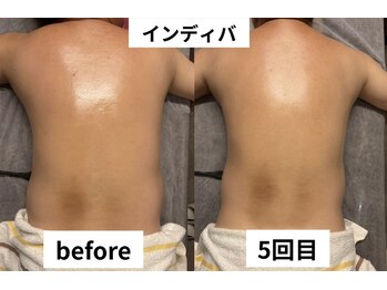 ゼロミリメートル(0mm)/【インディバ】ビフォーアフター