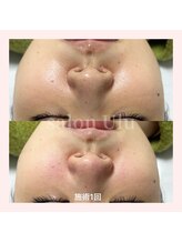 ウル(Ulu)/キレイな毛穴を維持！