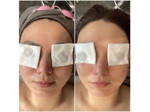 毛穴洗浄ピーリング×光フェイシャルで理想のお肌に◎