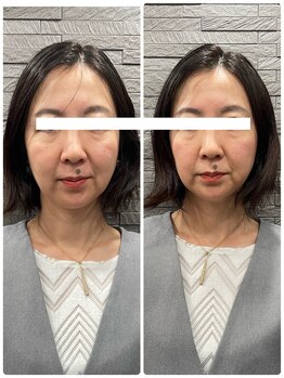 長寿鍼灸院 長寿整骨院/ハリネズミ女優美容鍼効果★