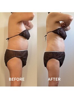 ブルーム(BLOOM)/３ヶ月痩身プログラム（上半身）