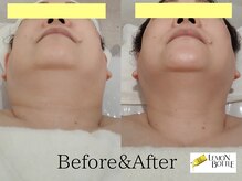 クリニカルエステ/イーズ パークプレイス大分店/40代～50代#顎下の脂肪#小顔